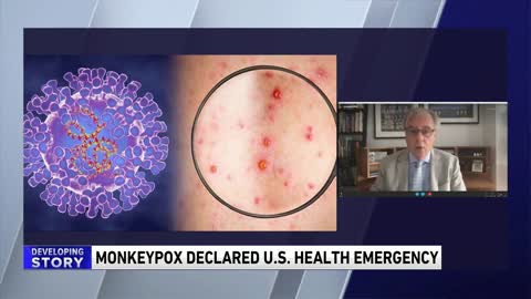 Dr. Murphy declares monkeypox a a public health emergency