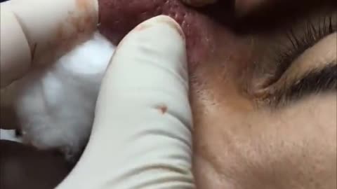 Pimples Removal - Blackhead Squeeze