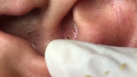 Removing Pimples and Blackheads from the Face, #8