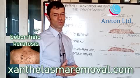 THE DIFFERENT METHODS OF HOW TO REMOVE SEBORRHEIC KERATOSIS