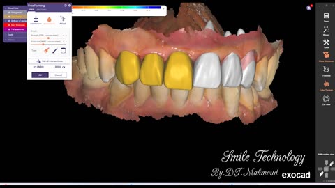 #design #naildesign #dental #dentaldesign #exocadexpert