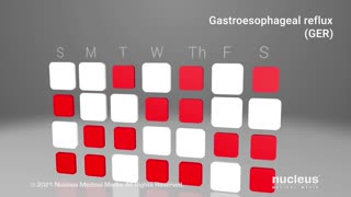 What is GERD?Most common disease world wide.