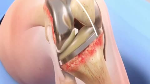 Revision Knee Surgery ( 3D Animation )