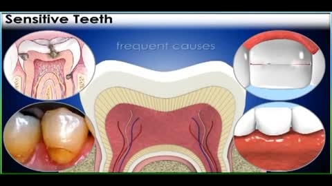 Tips to Help Sensitive Teeth | How to Reduce Teeth Sensitivity Dr.Mathesul Invisalign Invisible