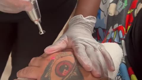 Singer Jimmy Levy Posted A Clip Of Him Getting His "Satanic Tattoo" Removed