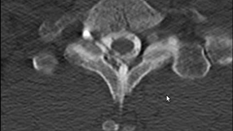 CSF leak compared to Dr Grey presentation