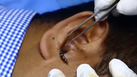 Insect in 👂 ear