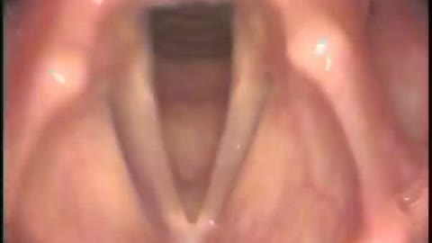 Normal female vocal cords - Stroboscopy