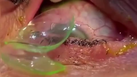 Ophthalmologist Removes 23 Contact Lenses From a Woman's Eye