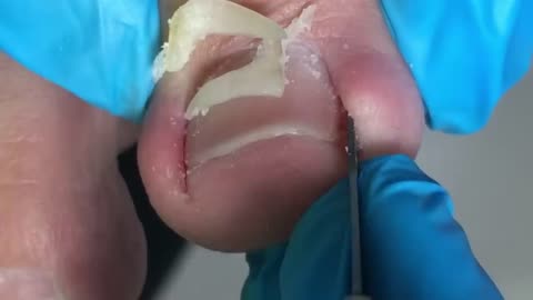 Super obvious ingrown toenail, completely repaired
