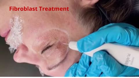 Fibroplasma by Samantha - Fibroblast Treatment in Beverly Hills, CA