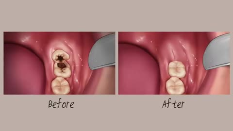 ASMR,Animation of tooth filling and teeth restoration