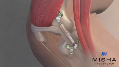 Moximed MISHA Knee System for Osteoarthritis - 3D animation