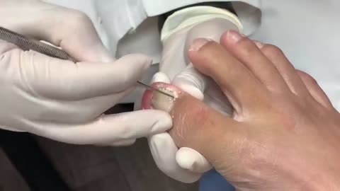 Did Tight Shoes Cause These Double Nails?! (INTENSE, LAYERED Nail Cutting)