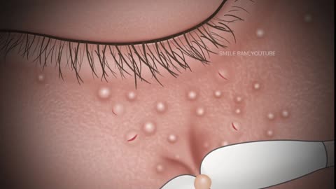 ASMR Satisfying Eye Mucus Fishing Syndrome Removal | Milium Under The Eyes Extraction Animation