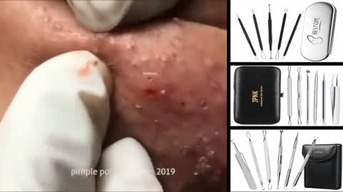 Blackheads Removal & Pimple Popping Videos 2020 ( beautiful girl )