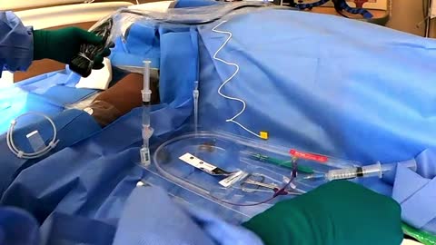 PICC insertion with the Sherlock 3CG Intracavitary ECG Catheter Tip Location Technique
