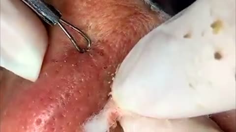 Satisfying Relaxing black heads removal Part I