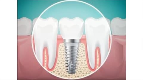 The Smile Institute | The Best Dental implants in San Antonio TX