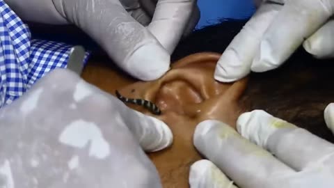 doctor try to remove insect