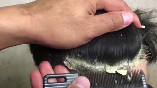 Serious and Oddly Satisfying Removal of Big Flakes Dandruff.