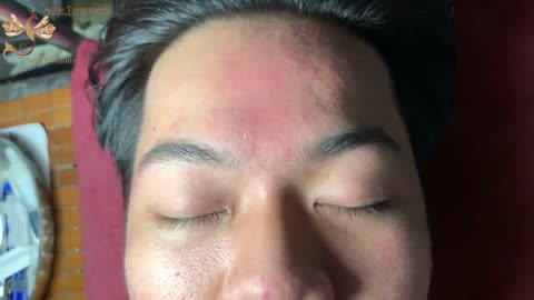 #071 | Acne Treatment Huong Beauty