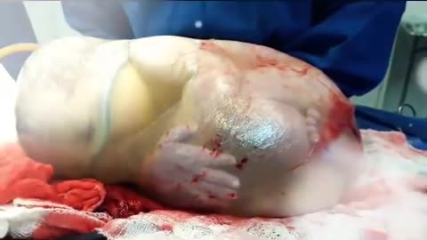 Born baby, still inside amniotic sac