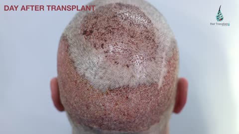 My 3500 GRAFTS HAIR TRANSPLANT EXPERIENCE AT ADON CLINIC MUMBAI: CASE STUDY CHRIS