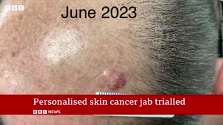 First 'personalised' melanoma skin cancervaccine trial under way in UK | BBC News