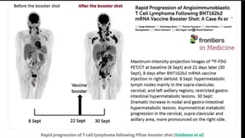 CANCER LINK WITH PFIZER mRNA BOOSTERS DR. CHARLES HOFFE EXPLAINS