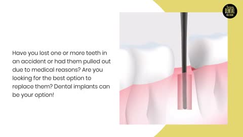 Special Advantages of Dental Implants