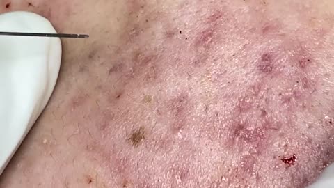 Big Cystic Acne Blackheads Extraction