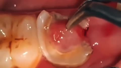 Pulp polyp inside tooth