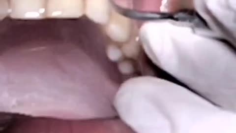 Teeth Scaling & polishing