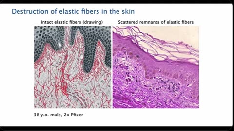 mRNA Injections Accelerate Ageing Process Explained by Pathologist Arne Burkhardt