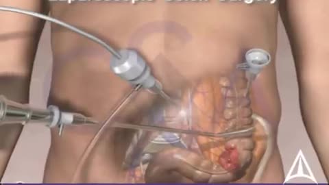 Colorectal cancer laparoscopic surgery - 3d animation