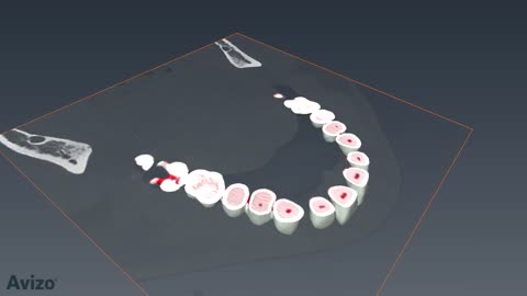 ***Amazing tooth segmentation video from FEI’s 3D visualization solution (Avizo3D.com) ***