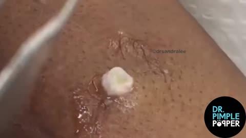 8 Minutes of Satisfying Soft Pops! Dr Pimple Popper POPS All Over The Body