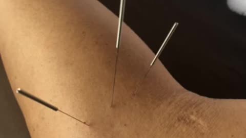 what is guiding needle acupuncture?