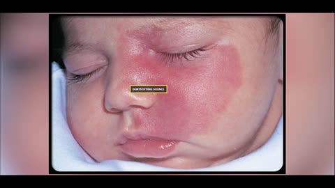 Birthmarks: Understanding the Types, Causes, and Treatment Options