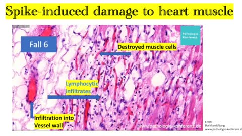 Vaccine related brain damage