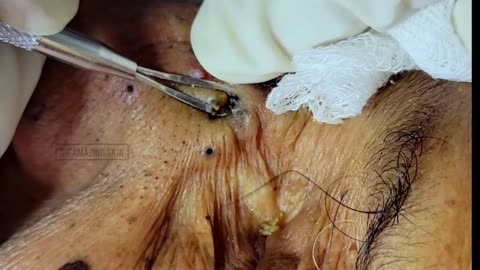 Massive blackhead removal inside a dermatology clinic