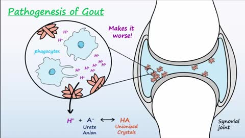 Gout - Mechanisms - Treatment