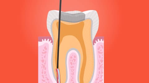 Tooth Root Canal Dental Implant