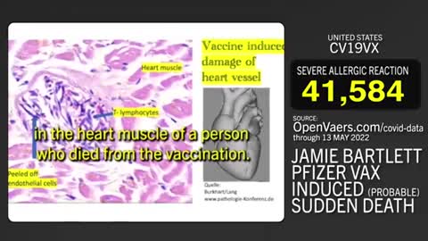 Actor who got "Pfizered right in his left shoulder" dead of cardiac arrest 🇺🇸Join Us