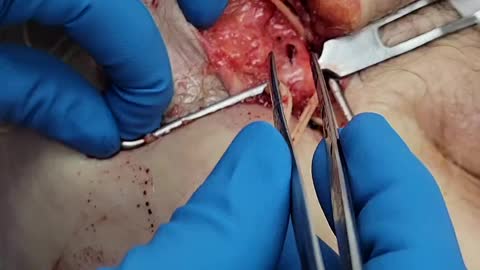 Embalmer Richard Hirschman Releases Footage of Unbelievable Blood Clots