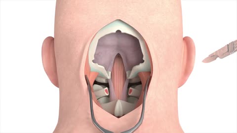 Craniectomy procedural 3D animation