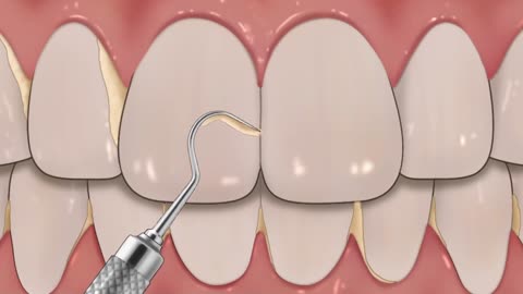 [ASMR] tartar removal animation / teeth scaling