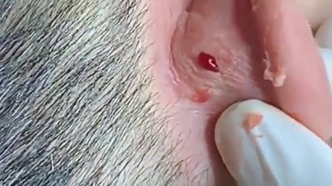 CRAZY PIMPLE POPPING CYST EXPLOSION BLACKH