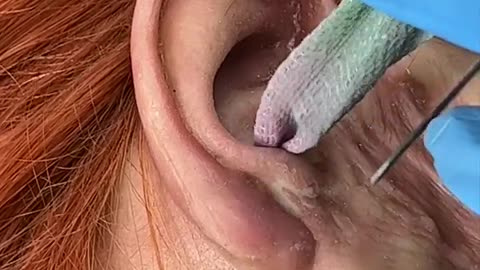 Ear Surgery